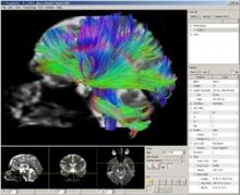Diffusion Toolkit with TrackVis, a cross-platform software package that does reconstruction, fiber tracking, visualization and analysis on various diffusion imaging data
