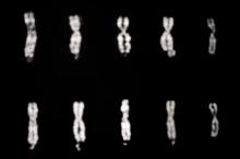 Fragile X syndrome involves changes in the X chromosome, as pictured in the four columns of chromosomes starting on the left. The fifth column, on the far right, shows two normal X chromosomes. 