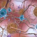 In this artist’s rendering, amyloid plaques are interspersed among neurons. These aggregates of misfolded proteins disrupt and kill brain cells, and are a hallmark of Alzheimer’s disease. Photo credit: National Institute of Aging